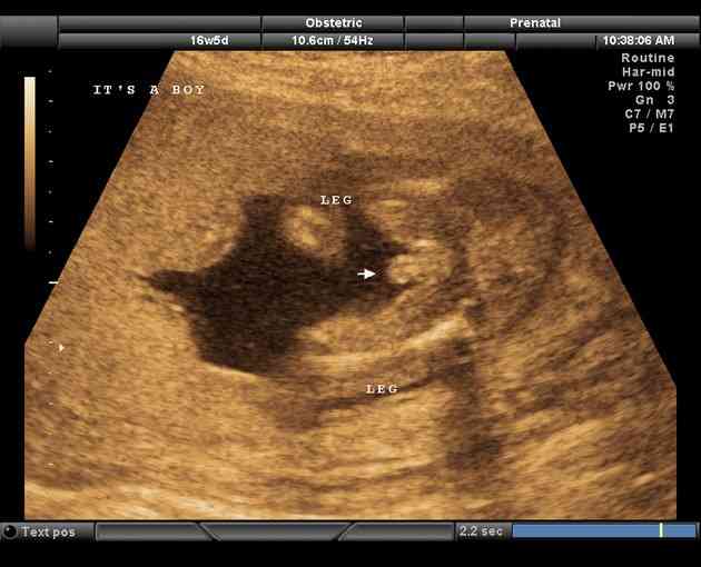 Узи плод женского пола. Мне ошиблись полом. Пол на узи. Как по узи определяют пол ребенка в 12 недель. Узи 20 недель беременности мальчик.